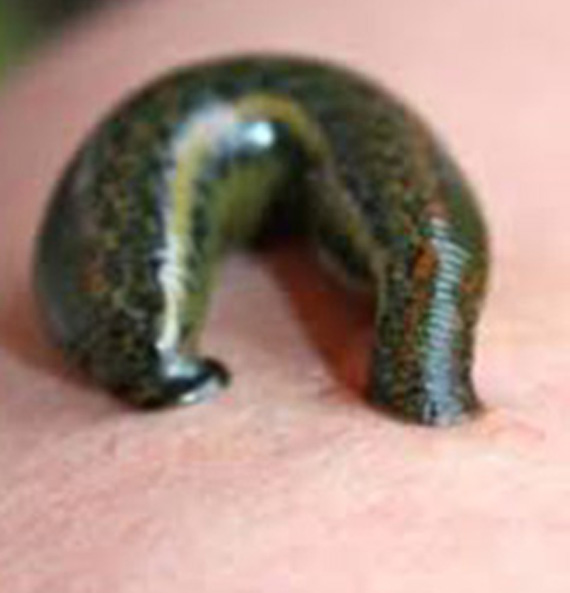 Raktamokshana therapy for detoxification at the Best Ayurveda Treatment Centre in India and the Best Ayurvedic Treatment in Tamil Nadu..